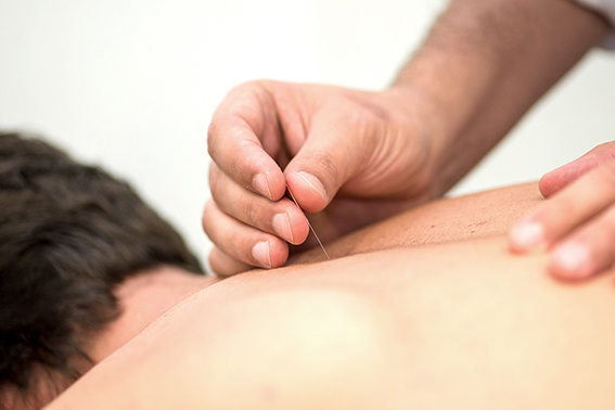 La punción seca, una técnica para aliviar el dolor muscular